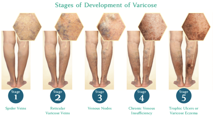 Varicose Veins: 7 Signs You Need to See a Vein Specialist